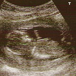 Baby Scan